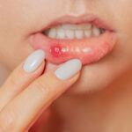 7 Common Causes of Sudden Blood Blisters in the Mouth