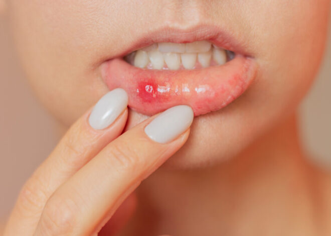 7 Common Causes of Sudden Blood Blisters in the Mouth