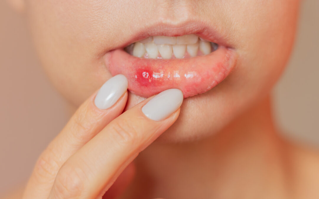 7 Common Causes of Sudden Blood Blisters in the Mouth