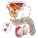 No Scalpel Vasectomy and Patient Preparation Checklist